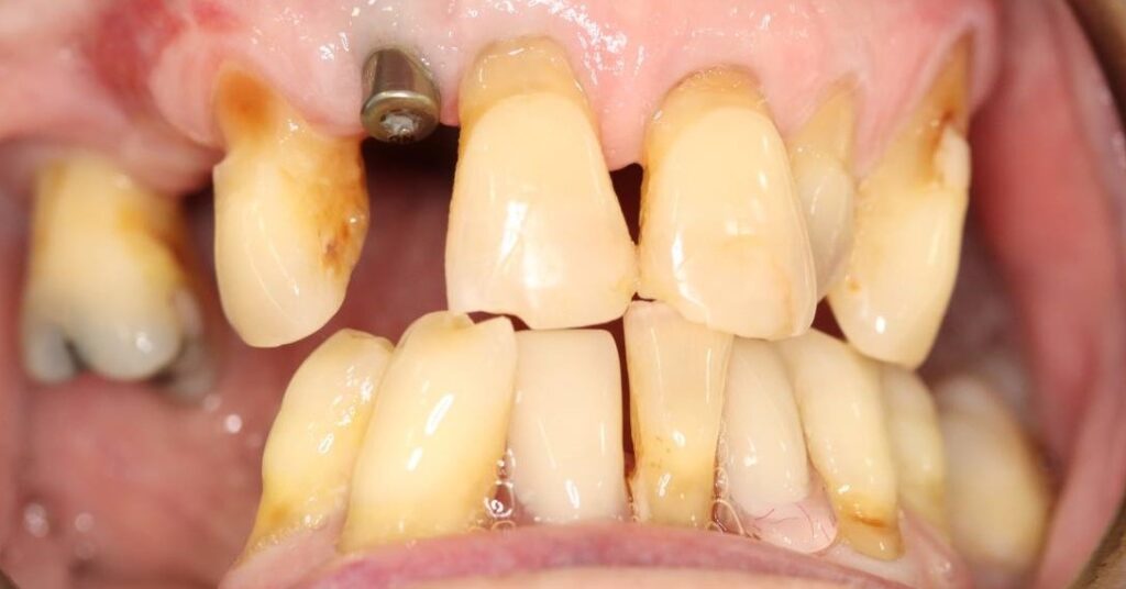 Before: Dental implant restoration. ❌Missing upper lateral tooth in the smile line . ❌Implant abutment visible before the final crown was fitted . ❌Noticeable space disrupting the continuity of the upper front teeth.