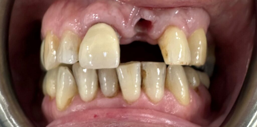 Before: Dental implant restoration. ❌Missing upper front tooth creating a visible gap . ❌Disrupted continuity across the upper smile . ❌Uneven appearance in the front-tooth region.