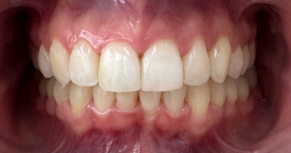 After: ✅ Straighter front tooth alignment . ✅ Reduced crowding and rotations . ✅ Brighter, fresher tooth shade . ✅ Smoother, more even tooth edges. ✅ A natural-looking smile transformation