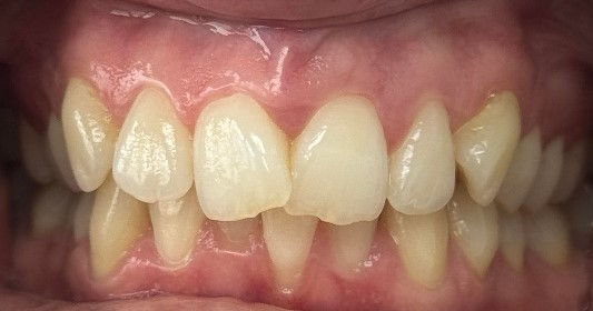 Before: ❌ Visible crowding and uneven alignment across the front teeth .  ❌ Rotated teeth affecting the overall smile balance . ❌ A darker tooth shade before whitening
