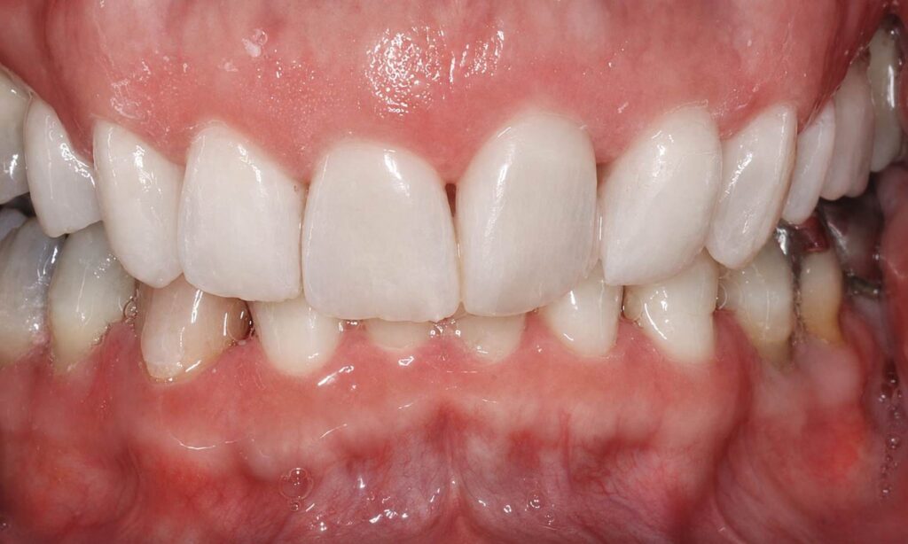 After: Whitening significantly brightened the teeth and reduced visible staining, creating a cleaner, lighter and more refreshed smile appearance.