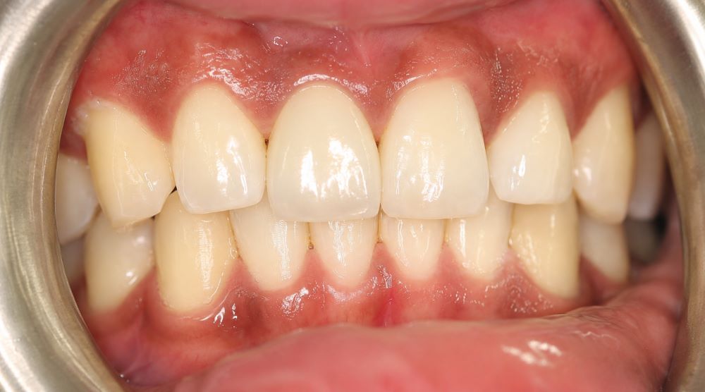 Upper front tooth restored with an implant-supported crown
