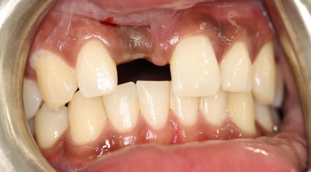 Missing upper front tooth before dental implant restoration