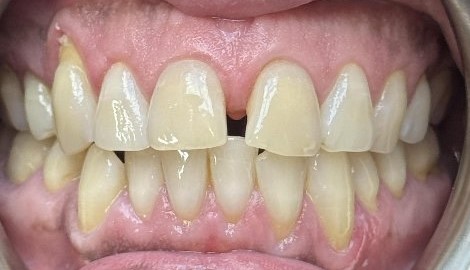 Upper front teeth with a prominent midline gap before treatment