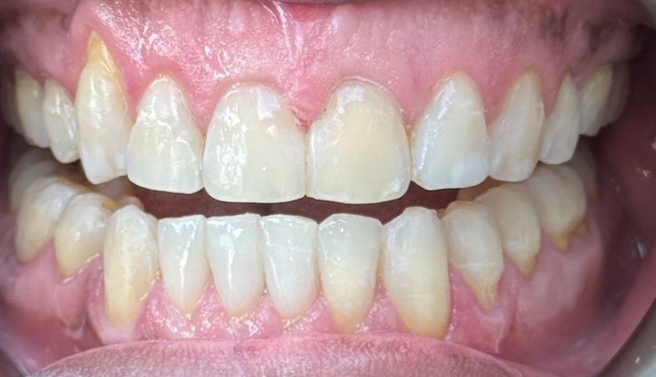 Upper front teeth with the midline gap closed after treatment