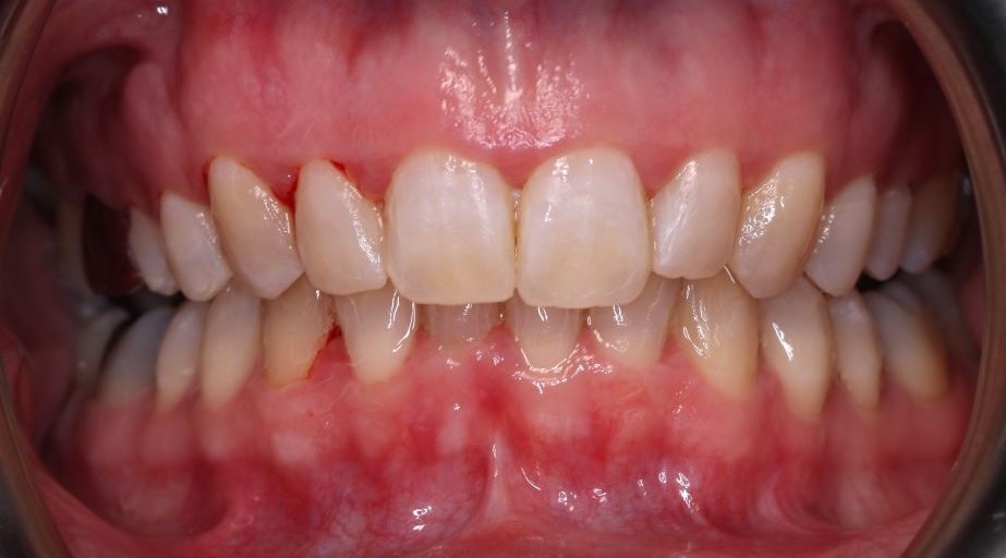 Improved upper and lower tooth alignment after treatment