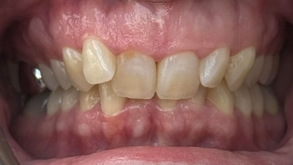 Crowded upper and lower teeth with prominent upper canines before treatment