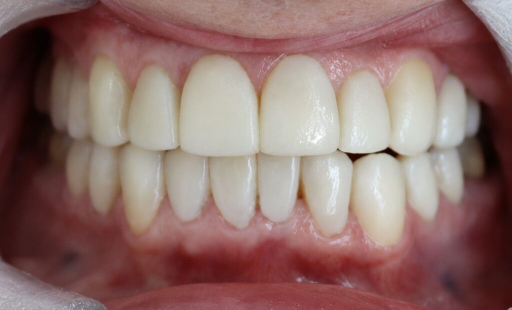 Restored upper and lower front teeth with improved shape and symmetry