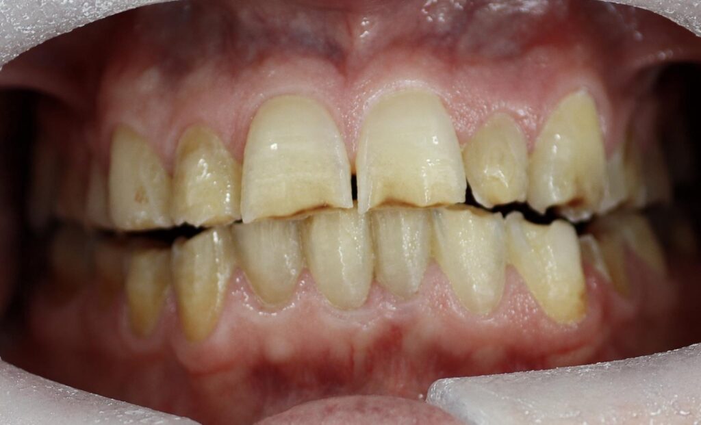 Worn and uneven upper and lower front teeth before restorative treatment