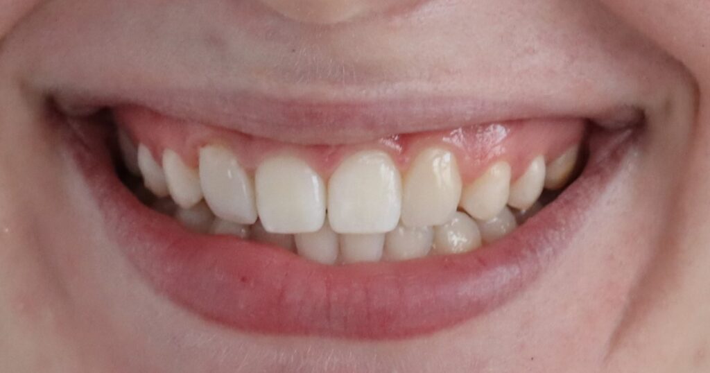 Upper lateral incisor with a fuller shape and improved proportions after composite bonding