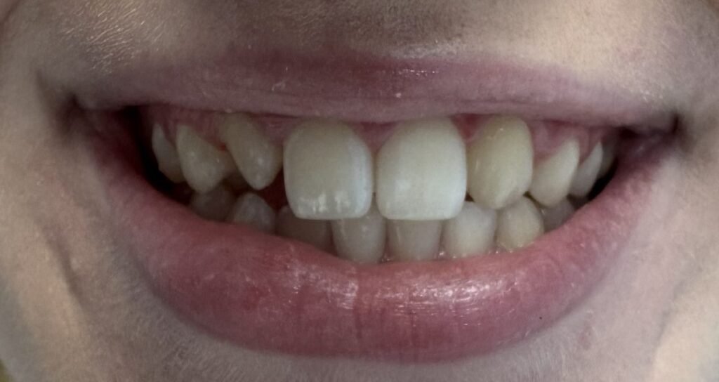 Small, tapered upper lateral incisor with uneven front-tooth proportions before composite bonding
