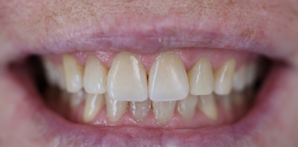 Upper front teeth with smoother edges and refined contours after composite bonding