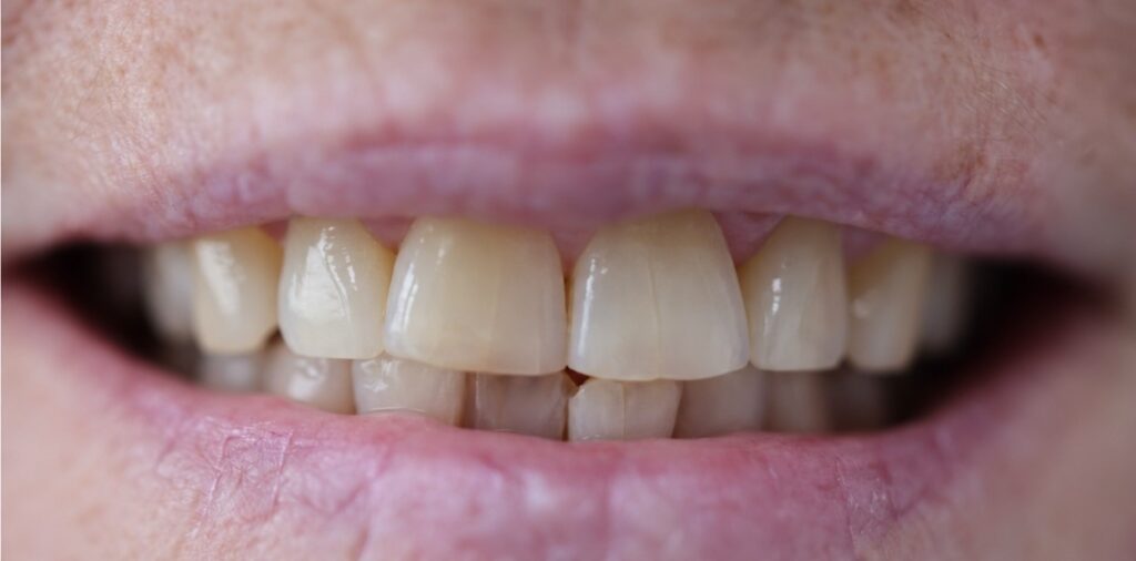 Upper front teeth with mildly uneven edges and differing contours before composite bonding