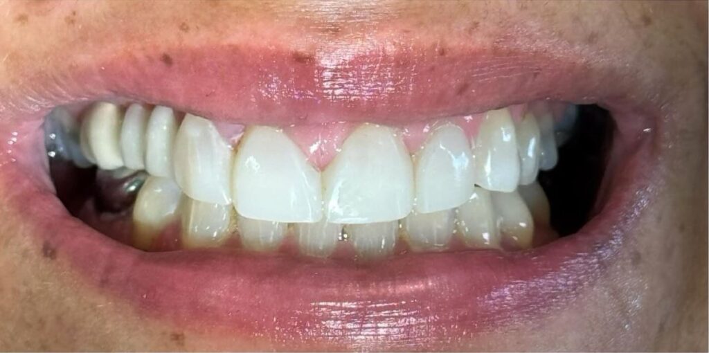 Upper central incisors with the visible midline gap closed after treatment