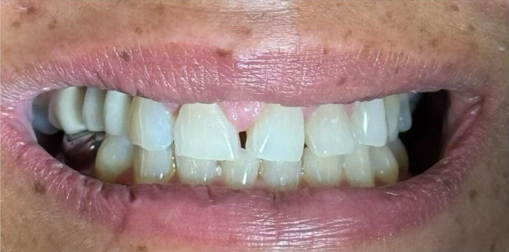 Visible midline gap between unevenly angled upper central incisors before gap-closure treatment