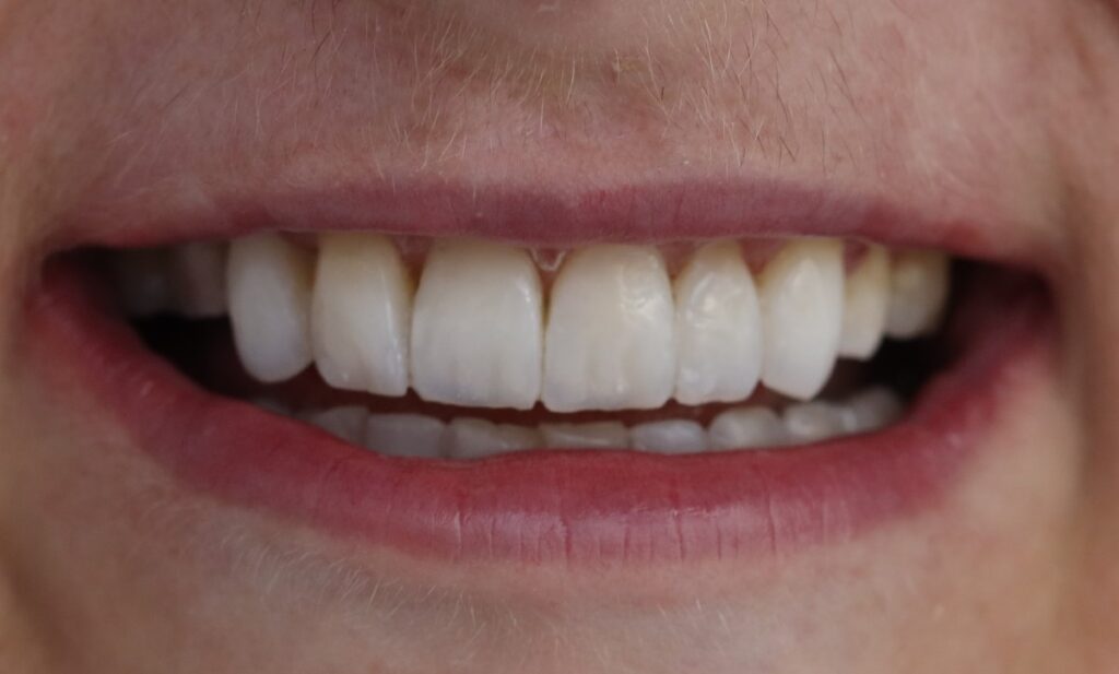 More evenly aligned upper front teeth after Invisalign treatment