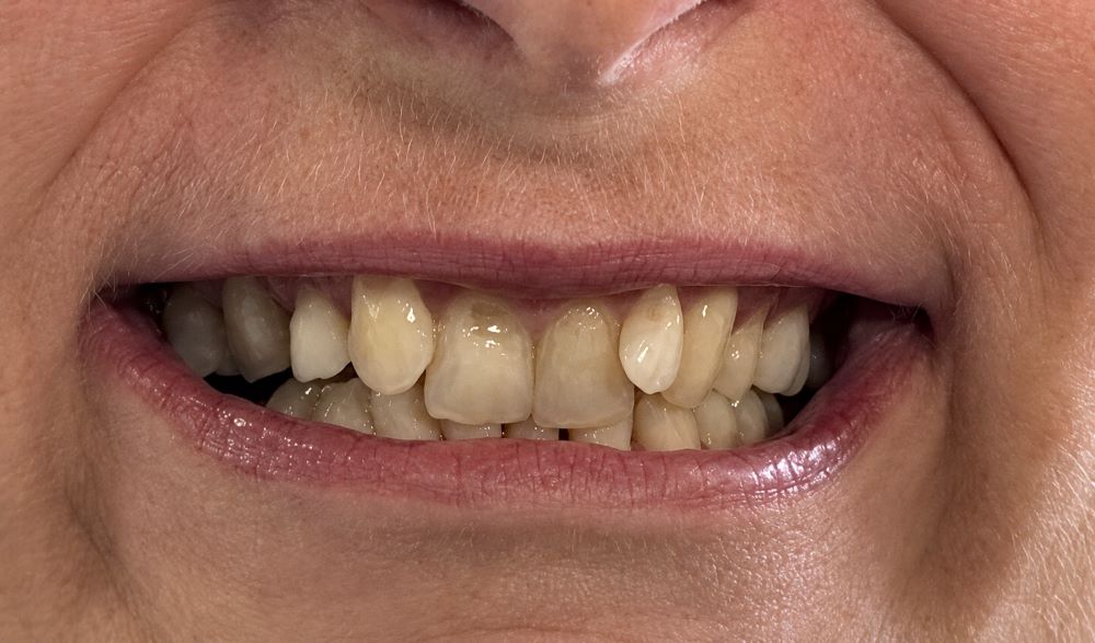 Crowded and overlapping upper front teeth before Invisalign treatment