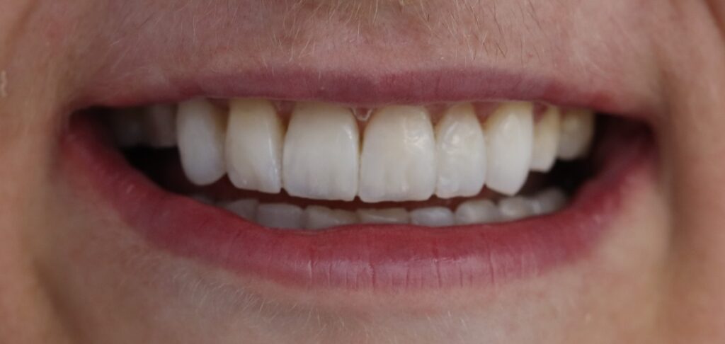 Upper front teeth with fuller shapes and more even edges after composite bonding