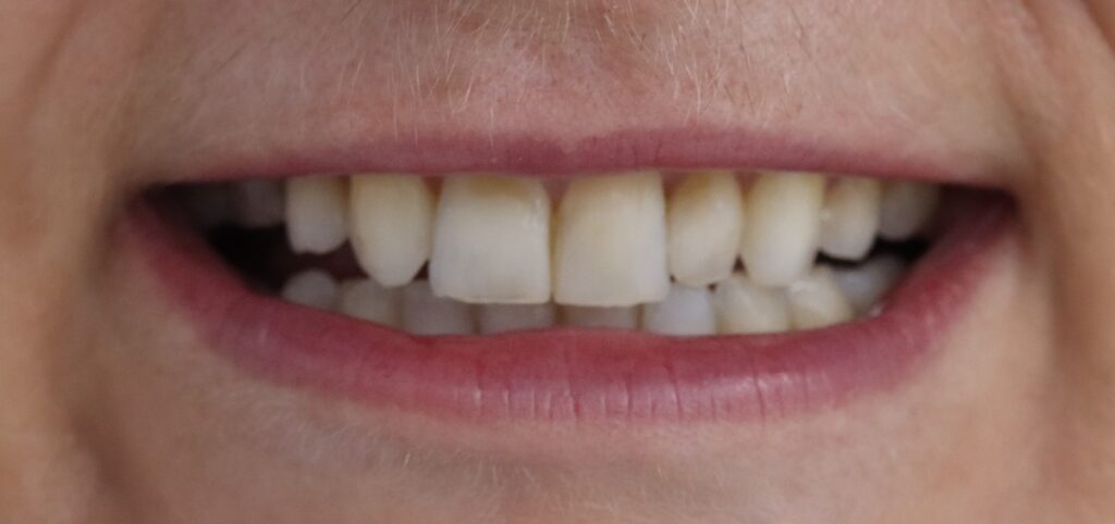 Upper front teeth with differing lengths and uneven contours before composite bonding